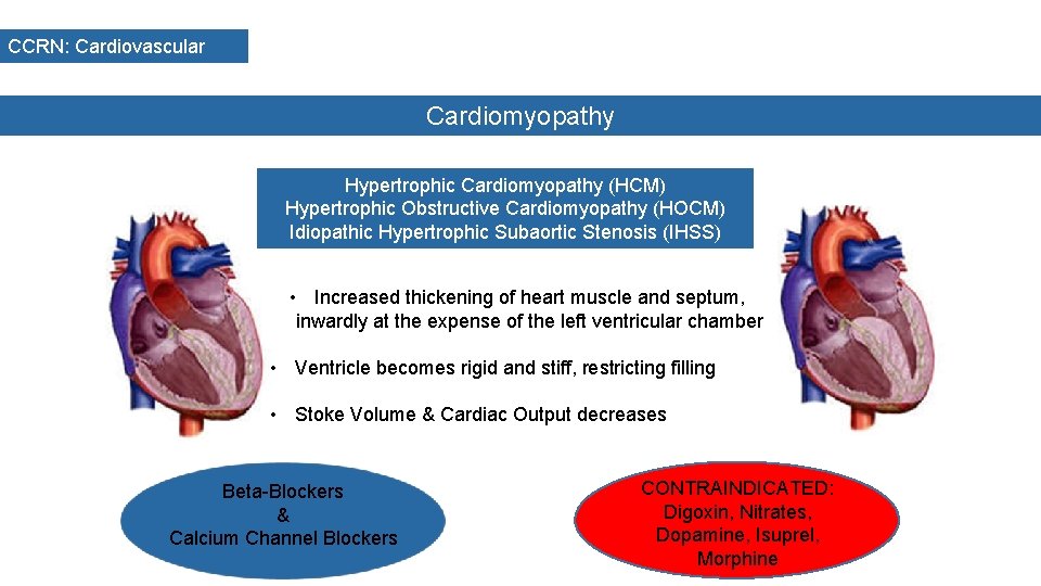 CCRN: Cardiovascular Cardiomyopathy Hypertrophic Cardiomyopathy (HCM) Hypertrophic Obstructive Cardiomyopathy (HOCM) Idiopathic Hypertrophic Subaortic Stenosis