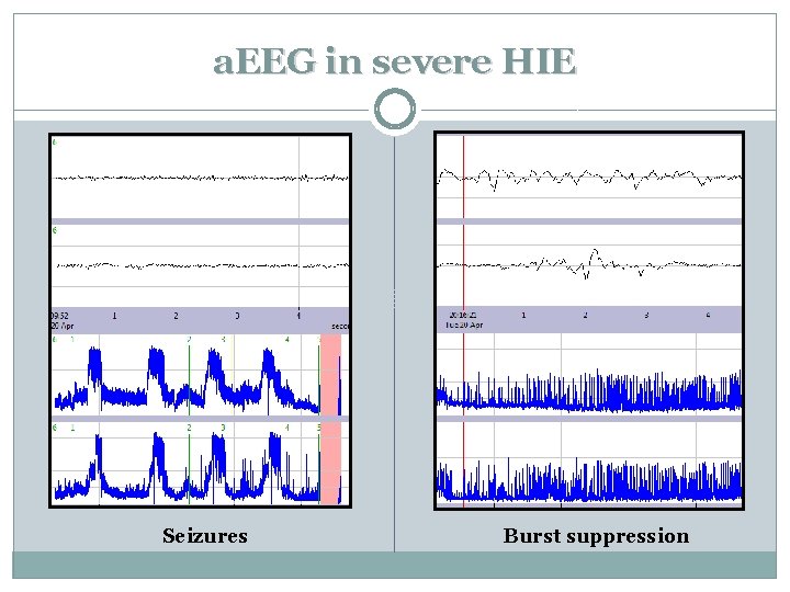 a. EEG in severe HIE Seizures Burst suppression 