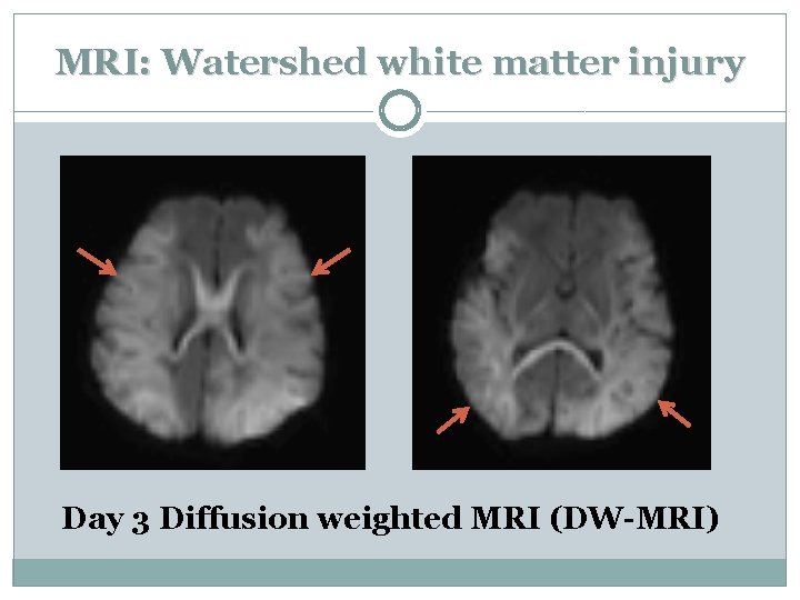 MRI: Watershed white matter injury Day 3 Diffusion weighted MRI (DW-MRI) 