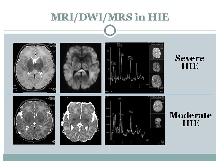 MRI/DWI/MRS in HIE Severe HIE Moderate HIE 