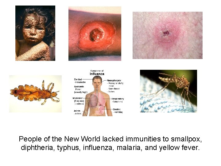 People of the New World lacked immunities to smallpox, diphtheria, typhus, influenza, malaria, and