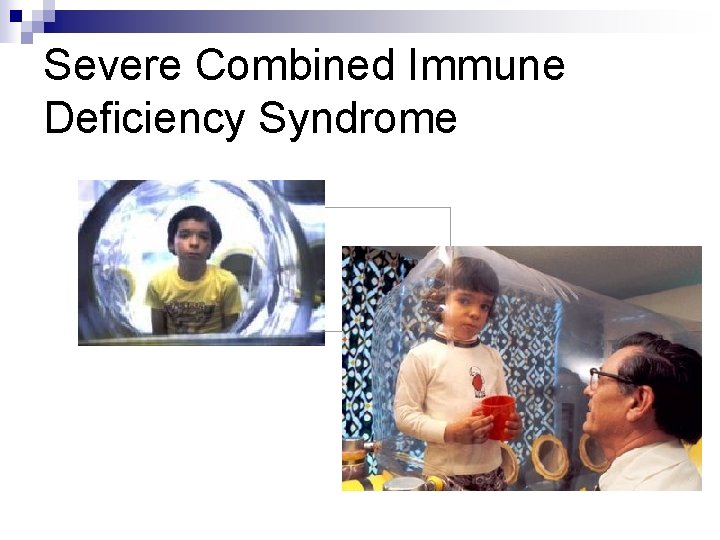 Severe Combined Immune Deficiency Syndrome 