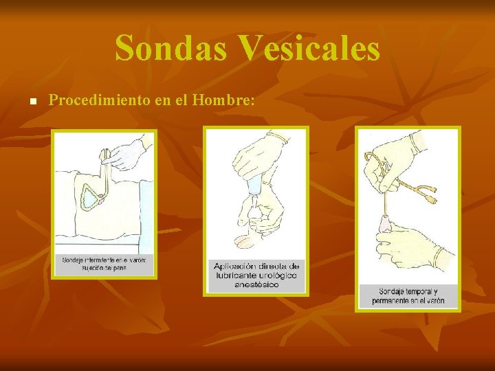 Sondas Vesicales n Procedimiento en el Hombre: 