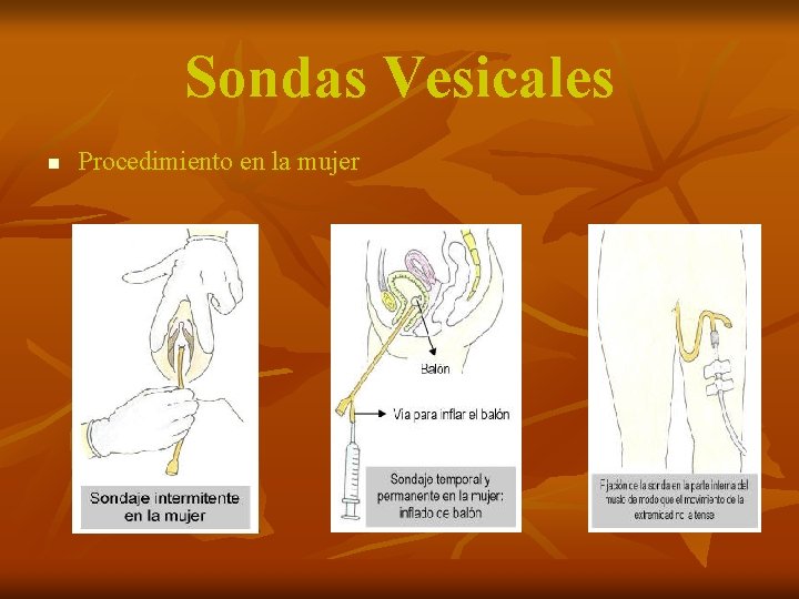 Sondas Vesicales n Procedimiento en la mujer 