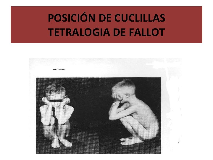 POSICIÓN DE CUCLILLAS TETRALOGIA DE FALLOT 