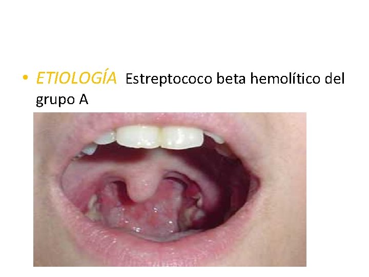 • ETIOLOGÍA Estreptococo beta hemolítico del grupo A 