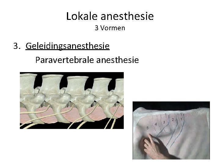 Lokale anesthesie 3 Vormen 3. Geleidingsanesthesie Paravertebrale anesthesie 