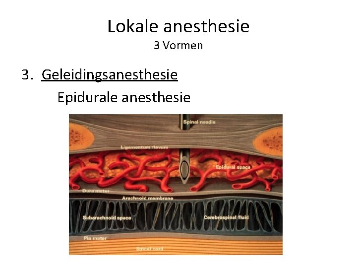 Lokale anesthesie 3 Vormen 3. Geleidingsanesthesie Epidurale anesthesie 