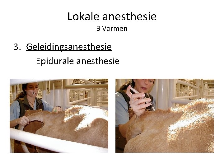 Lokale anesthesie 3 Vormen 3. Geleidingsanesthesie Epidurale anesthesie 