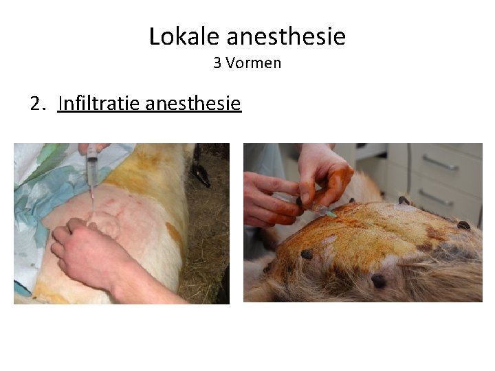 Lokale anesthesie 3 Vormen 2. Infiltratie anesthesie 