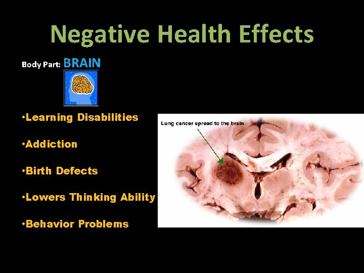 Negative Health Effects Body Part: BRAIN • Learning Disabilities • Addiction • Birth Defects