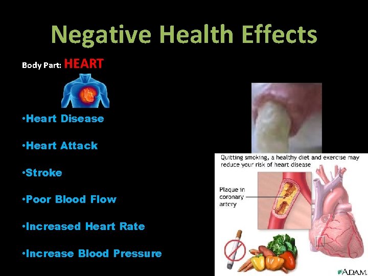 Negative Health Effects Body Part: HEART • Heart Disease • Heart Attack • Stroke