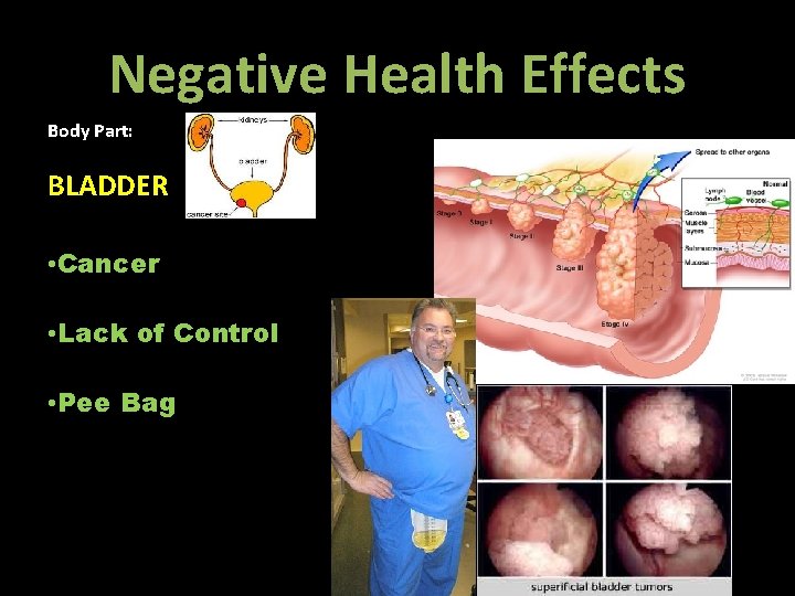 Negative Health Effects Body Part: BLADDER • Cancer • Lack of Control • Pee