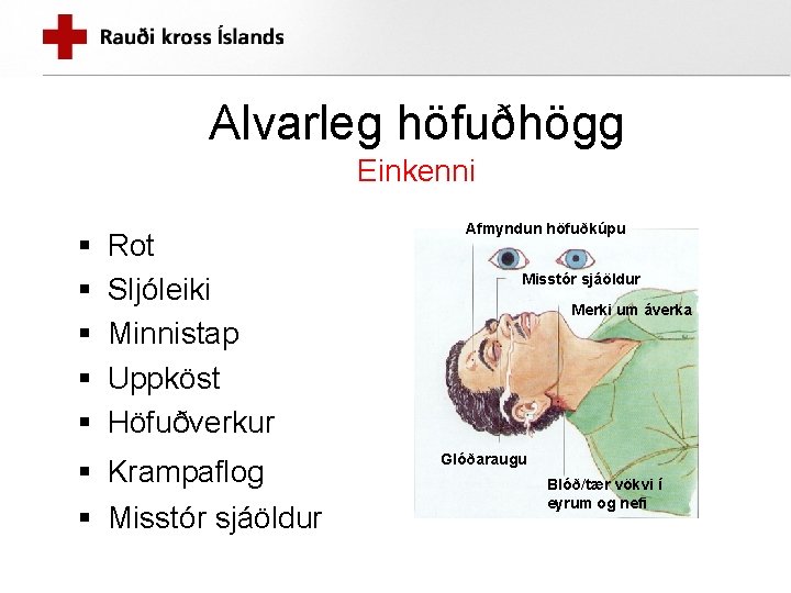 Alvarleg höfuðhögg Einkenni § § § Rot Sljóleiki Minnistap Uppköst Höfuðverkur § Krampaflog §