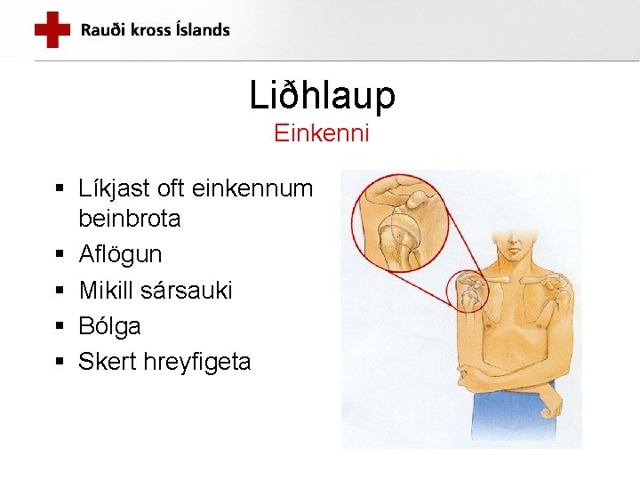 Liðhlaup Einkenni § Líkjast oft einkennum beinbrota § Aflögun § Mikill sársauki § Bólga