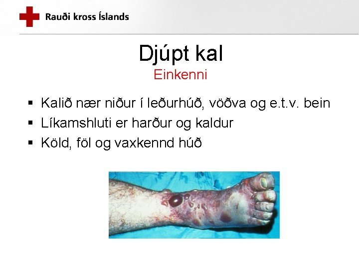 Djúpt kal Einkenni § Kalið nær niður í leðurhúð, vöðva og e. t. v.