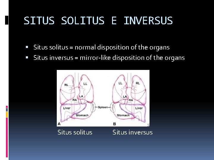 SITUS SOLITUS E INVERSUS Situs solitus = normal disposition of the organs Situs inversus SITUS SOLITUS E INVERSUS Situs solitus = normal disposition of the organs Situs inversus