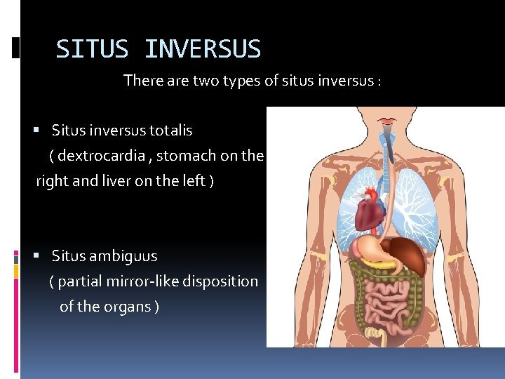 SITUS INVERSUS There are two types of situs inversus : Situs inversus totalis (