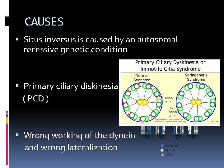 CAUSES Situs inversus is caused by an autosomal recessive genetic condition Primary ciliary diskinesia