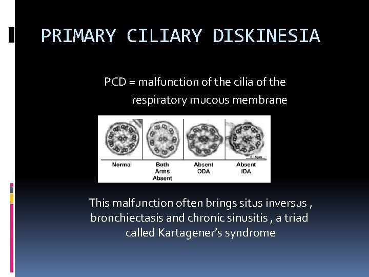 PRIMARY CILIARY DISKINESIA PCD = malfunction of the cilia of the respiratory mucous membrane PRIMARY CILIARY DISKINESIA PCD = malfunction of the cilia of the respiratory mucous membrane