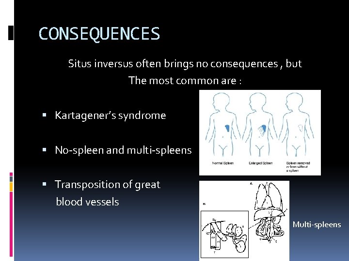 CONSEQUENCES Situs inversus often brings no consequences , but The most common are :