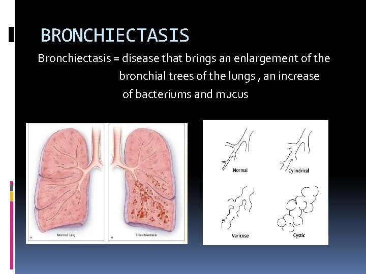 BRONCHIECTASIS Bronchiectasis = disease that brings an enlargement of the bronchial trees of the