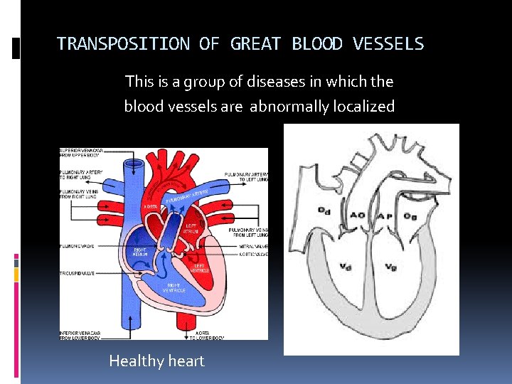 TRANSPOSITION OF GREAT BLOOD VESSELS This is a group of diseases in which the