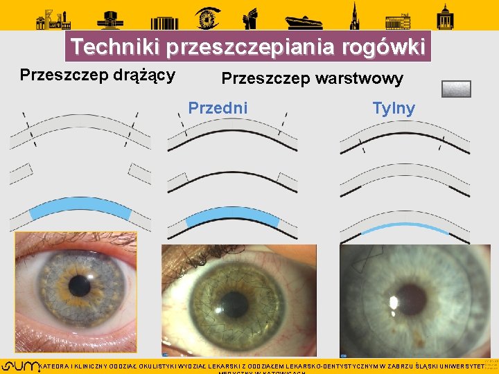 Techniki przeszczepiania rogówki Przeszczep drążący Przeszczep warstwowy Przedni Tylny CC BY 4. 0 KATEDRA