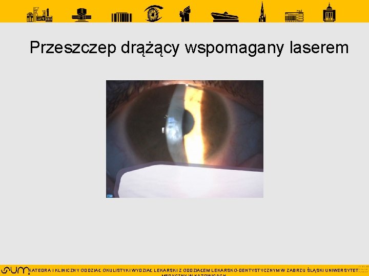 Przeszczep drążący wspomagany laserem CC BY 4. 0 KATEDRA I KLINICZNY ODDZIAŁ OKULISTYKI WYDZIAŁ