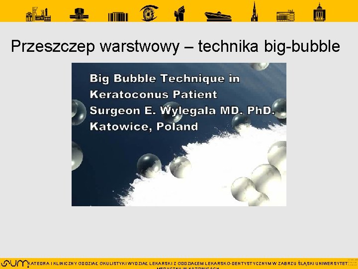 Przeszczep warstwowy – technika big-bubble CC BY 4. 0 KATEDRA I KLINICZNY ODDZIAŁ OKULISTYKI Przeszczep warstwowy – technika big-bubble CC BY 4. 0 KATEDRA I KLINICZNY ODDZIAŁ OKULISTYKI