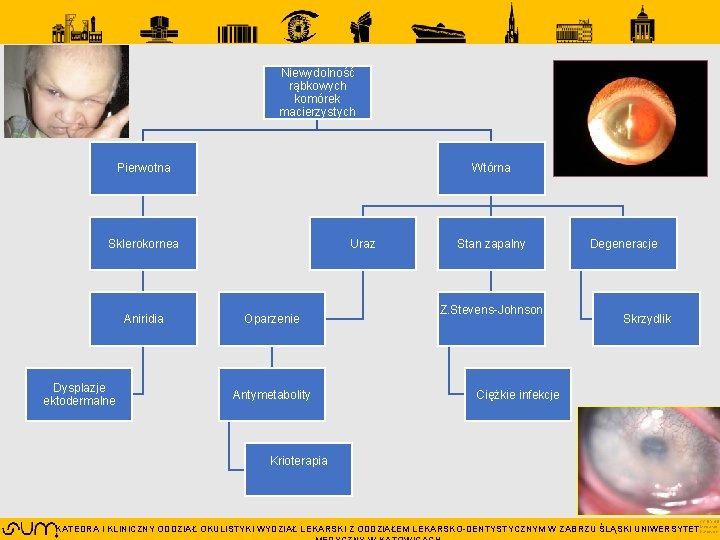 Niewydolność rąbkowych komórek macierzystych Pierwotna Wtórna Sklerokornea Aniridia Dysplazje ektodermalne Uraz Oparzenie Antymetabolity Stan Niewydolność rąbkowych komórek macierzystych Pierwotna Wtórna Sklerokornea Aniridia Dysplazje ektodermalne Uraz Oparzenie Antymetabolity Stan