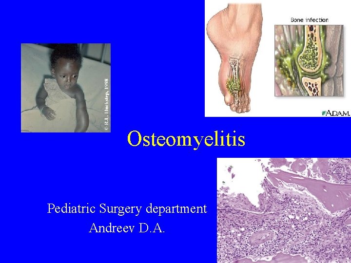 Osteomyelitis Pediatric Surgery department Andreev D. A. Osteomyelitis Pediatric Surgery department Andreev D. A.