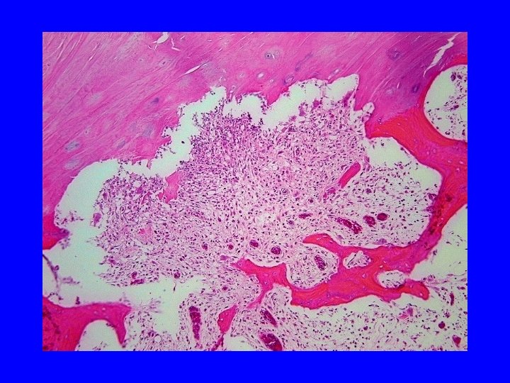 If the osteomyelitic process is not recognized • when it is still in the If the osteomyelitic process is not recognized • when it is still in the