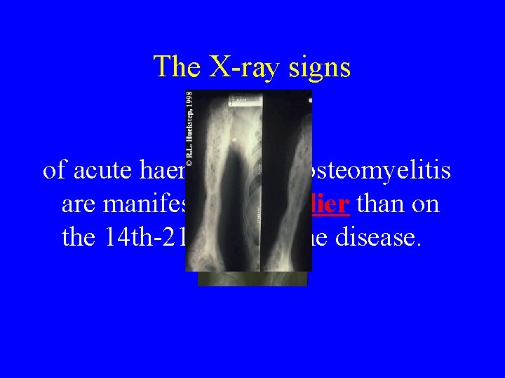 The X ray signs of acute haematogenic osteomyelitis are manifested no earlier than on The X ray signs of acute haematogenic osteomyelitis are manifested no earlier than on