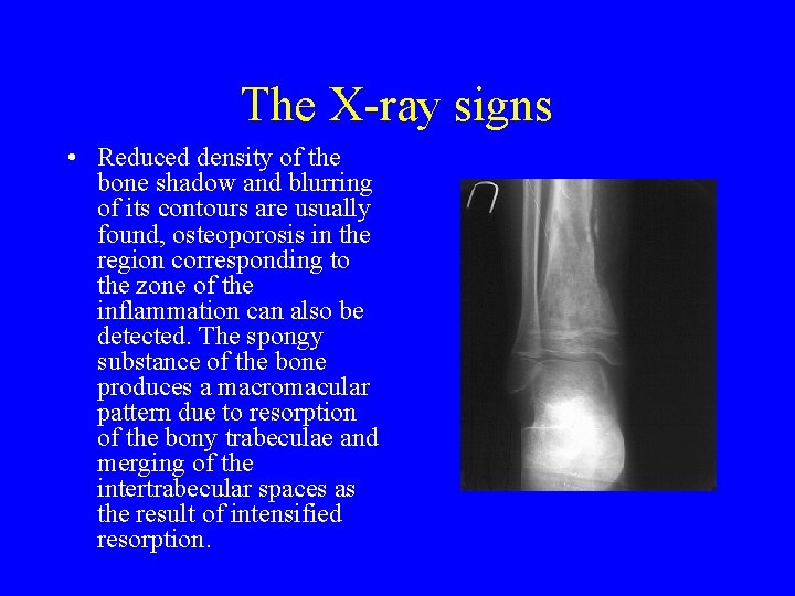The X ray signs • Reduced density of the bone shadow and blurring of The X ray signs • Reduced density of the bone shadow and blurring of