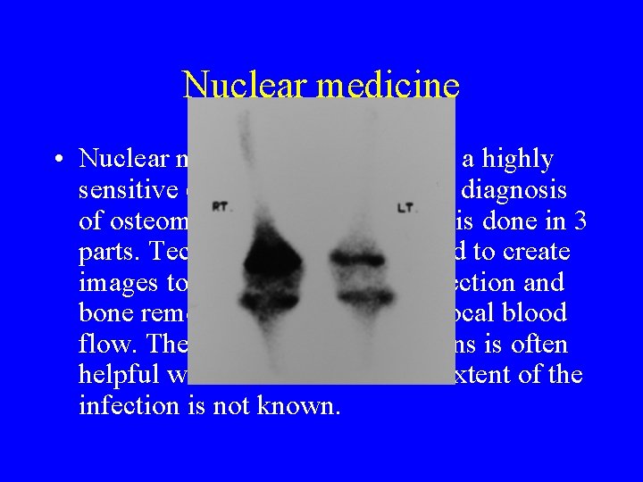 Nuclear medicine • Nuclear medicine bone scans are a highly sensitive (>90%) modality in Nuclear medicine • Nuclear medicine bone scans are a highly sensitive (>90%) modality in