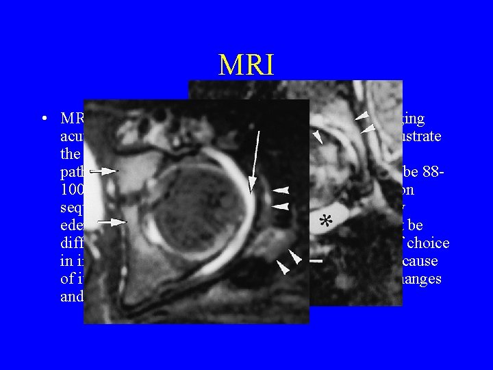 MRI • MRI if available is another useful modality for imaging acute osteomyelitis. Findings MRI • MRI if available is another useful modality for imaging acute osteomyelitis. Findings