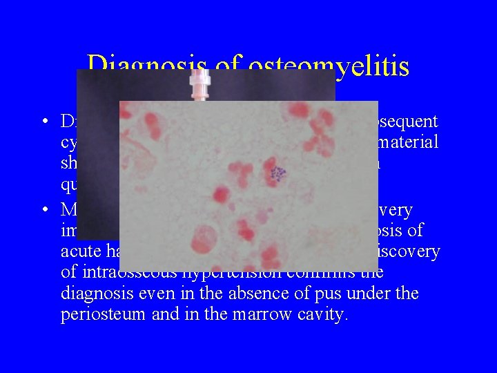 Diagnosis of osteomyelitis • Diagnostic puncture of the bone with subsequent cytological examination of Diagnosis of osteomyelitis • Diagnostic puncture of the bone with subsequent cytological examination of