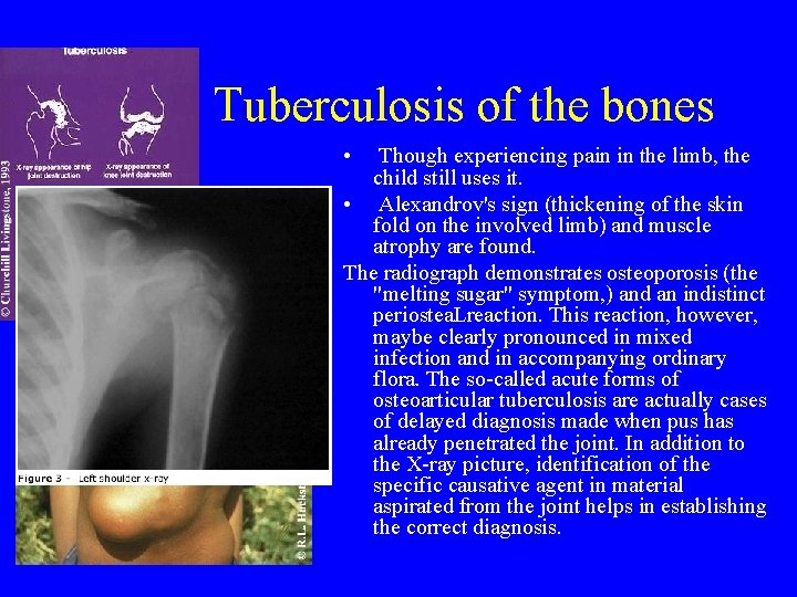 Tuberculosis of the bones • Though experiencing pain in the limb, the child still Tuberculosis of the bones • Though experiencing pain in the limb, the child still