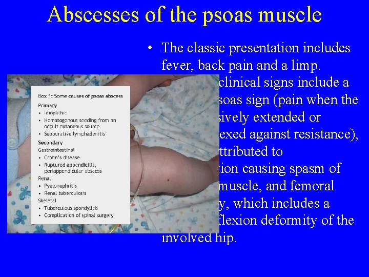 Abscesses of the psoas muscle • The classic presentation includes fever, back pain and Abscesses of the psoas muscle • The classic presentation includes fever, back pain and
