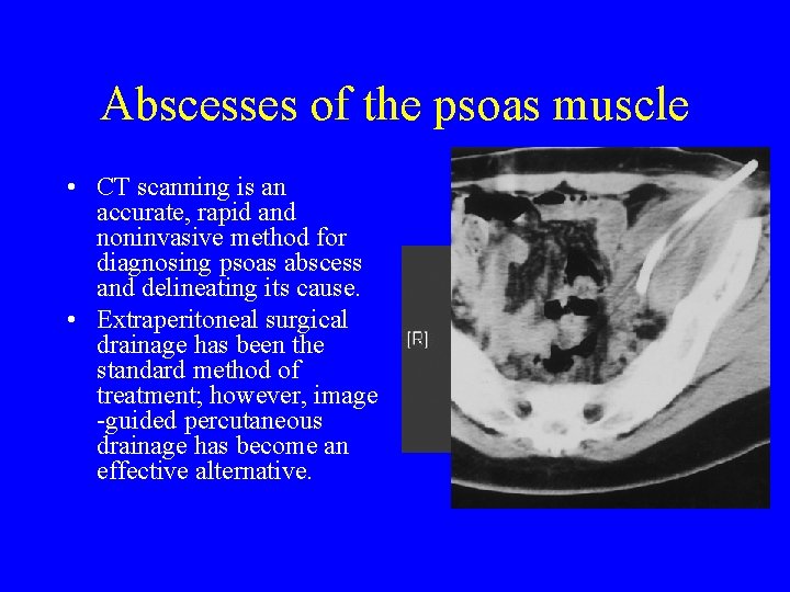Abscesses of the psoas muscle • CT scanning is an accurate, rapid and noninvasive Abscesses of the psoas muscle • CT scanning is an accurate, rapid and noninvasive