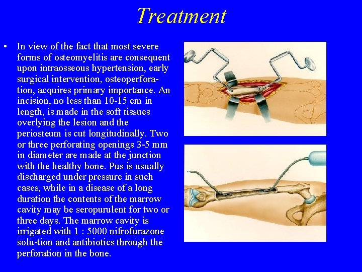 Treatment • In view of the fact that most severe forms of osteomyelitis are Treatment • In view of the fact that most severe forms of osteomyelitis are