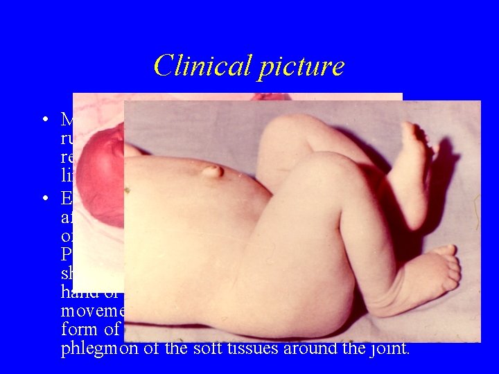 Clinical picture • Metaepiphyseal osteomyelitis sets in acutely as a rule with a rise Clinical picture • Metaepiphyseal osteomyelitis sets in acutely as a rule with a rise