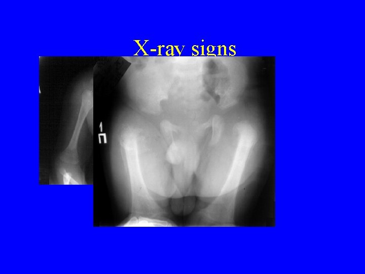 X ray signs X ray signs