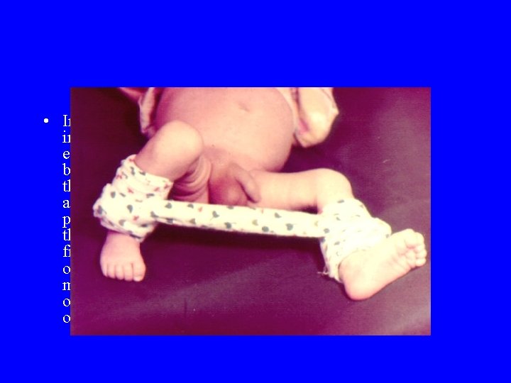 • In location of the process in the proximal femoral epiphysis, spreader bandages • In location of the process in the proximal femoral epiphysis, spreader bandages