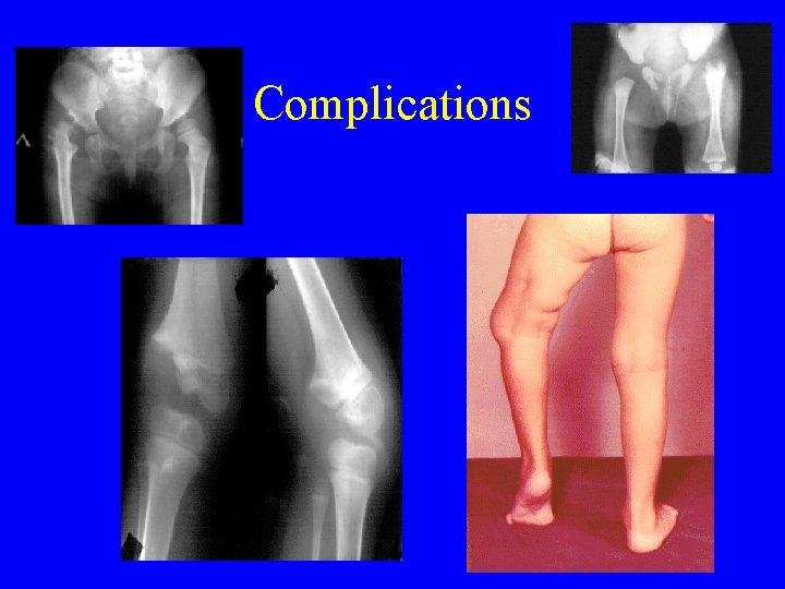 Complications Complications
