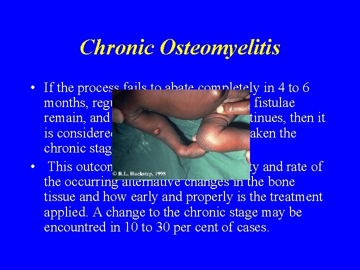 Chronic Osteomyelitis • If the process fails to abate completely in 4 to 6 Chronic Osteomyelitis • If the process fails to abate completely in 4 to 6