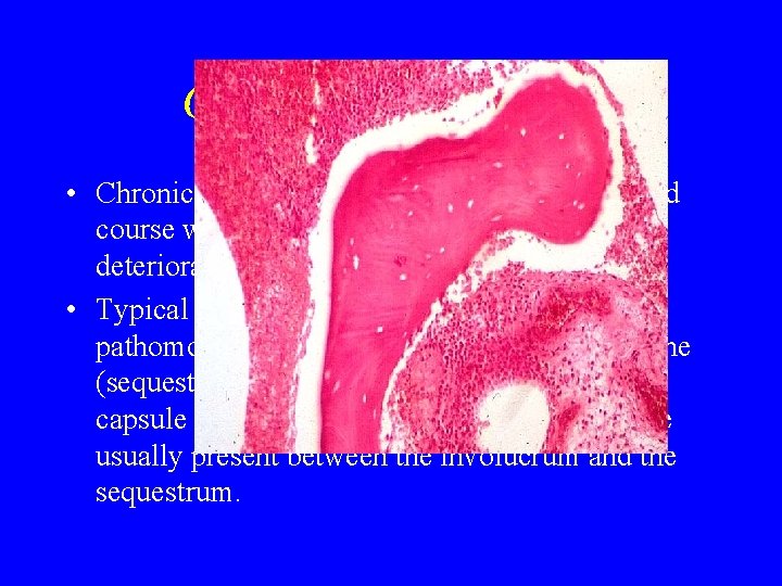 Chronic osteomyelitis • Chronic osteomyelitis is marked by a prolonged course with remissions and Chronic osteomyelitis • Chronic osteomyelitis is marked by a prolonged course with remissions and