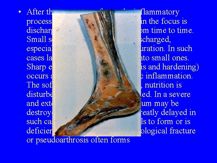 • After the sequestrum forms the inflammatory process continues. Pus collecting in the • After the sequestrum forms the inflammatory process continues. Pus collecting in the