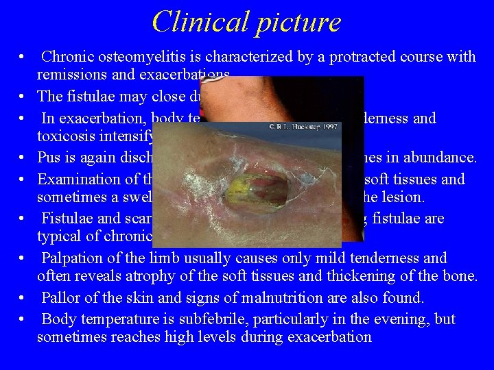 Clinical picture • Chronic osteomyelitis is characterized by a protracted course with remissions and Clinical picture • Chronic osteomyelitis is characterized by a protracted course with remissions and
